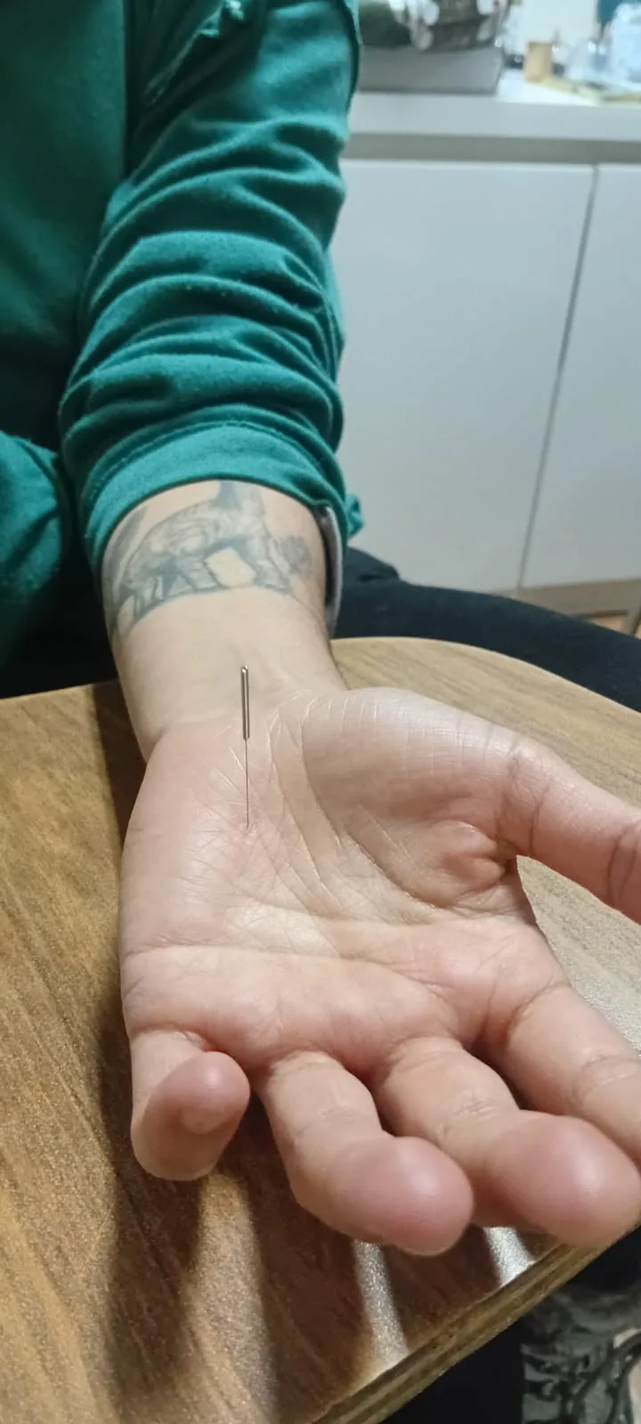 Detalle de aguja de acupuntura en la muñeca