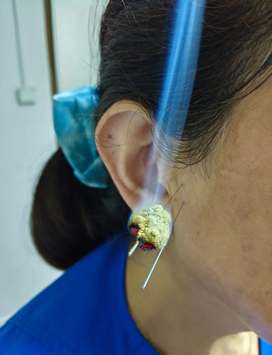 Sesión de auriculoterapia en la clínica Shaofu