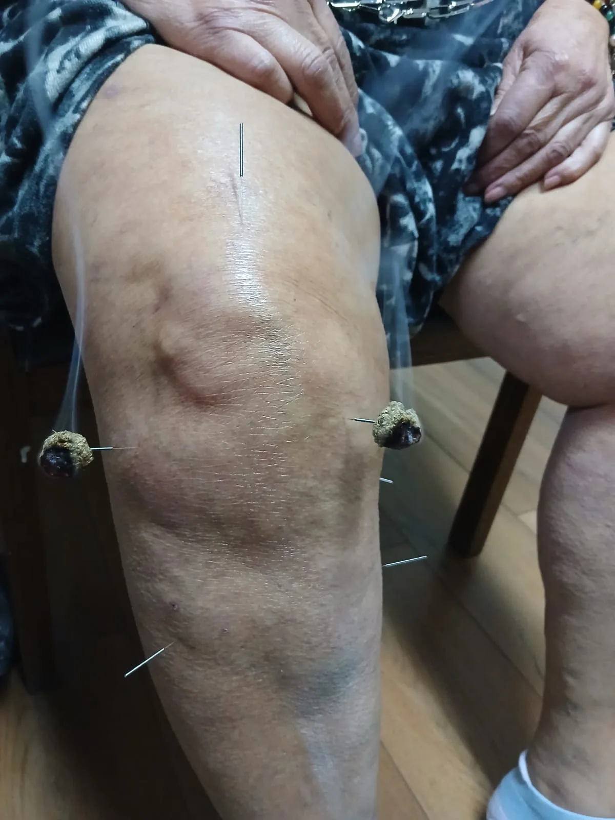 Tratamiento de moxibustión y acupuntura en rodilla